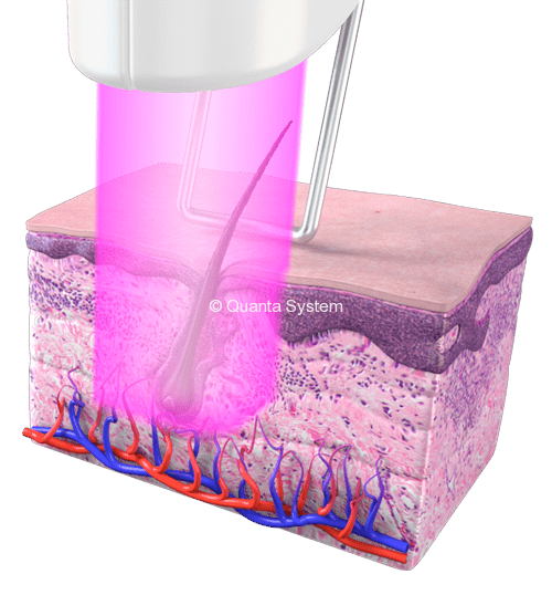 Thunder Laser Technologie